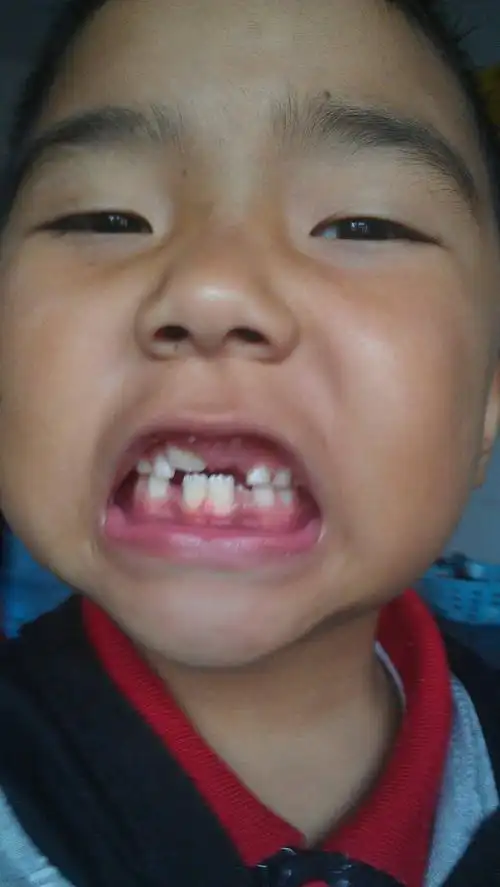 2014-01-22 尚剑 医师 我的牙齿有点爆,如果矫正的话,是不是非要带