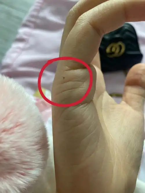 当我突然发现手上长了一颗黑痣时