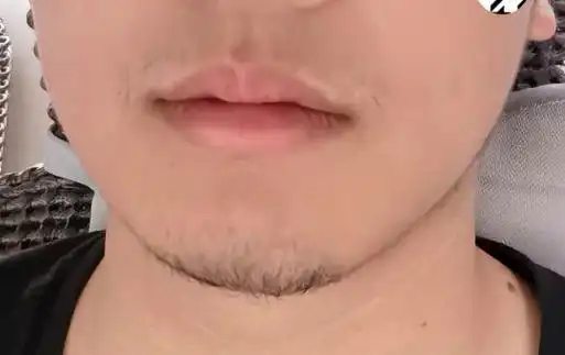 不想刮胡子怎么办胡子长太快了吧而且脖子和下巴侧面都有了请教一下