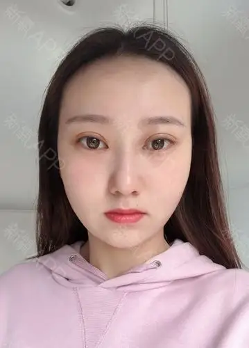 在薇琳做双眼皮已经20天啦