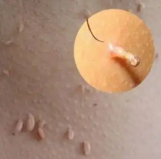 这些小肉粒是什么?对身体有影响吗?