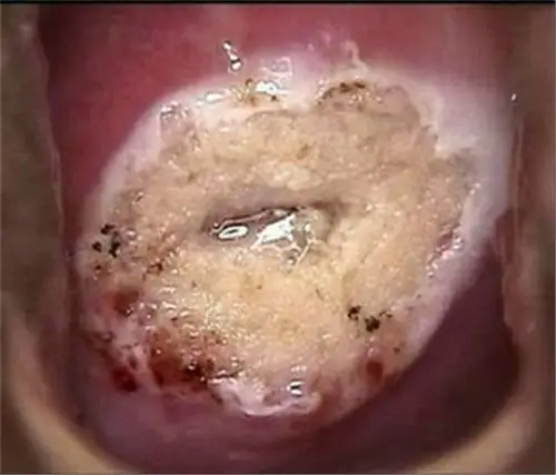 关于妇科宫颈糜烂的图片