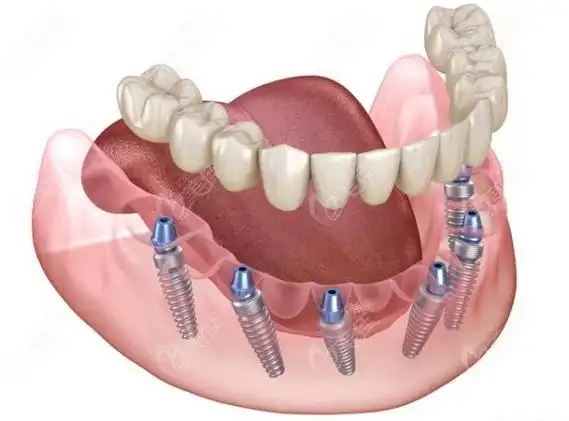 杭州上城区医院牙科种植牙价格一颗2980元起全口种植牙40000元起