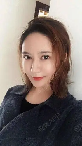 自体脂肪面部填充术后4天_面部填充术后4天_双眼皮术后4天_自体脂肪术