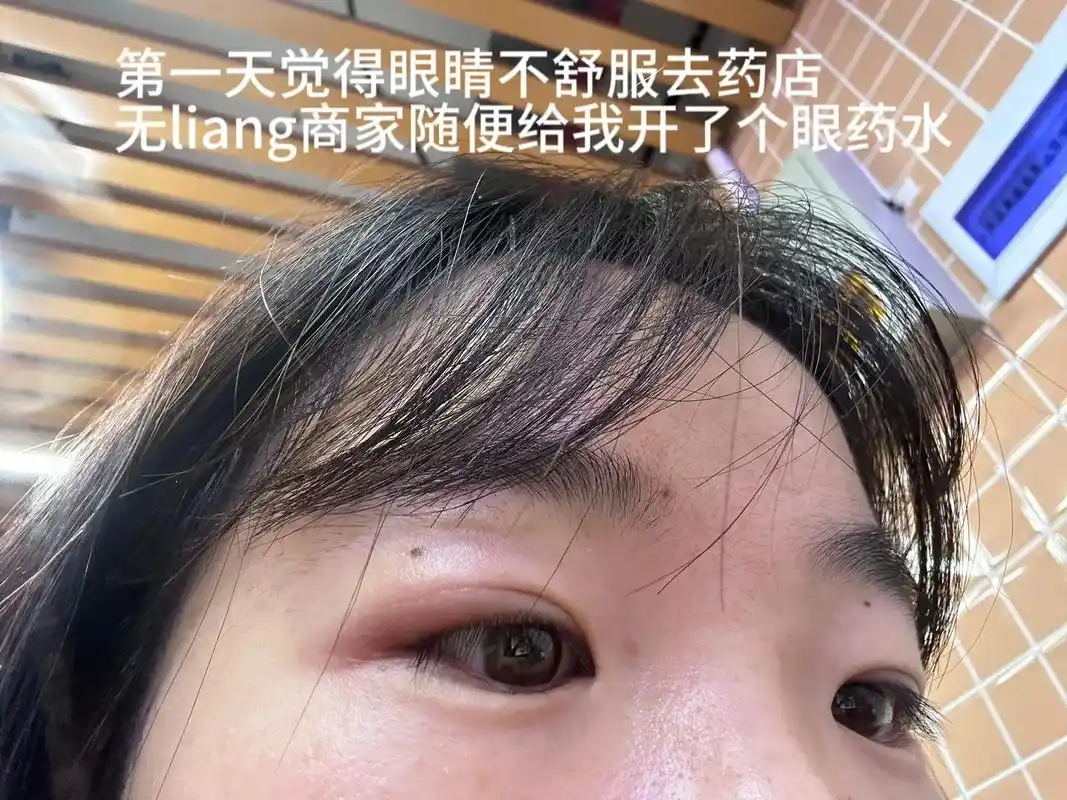 麦粒肿 #眼睑蜂窝组织炎 大家平时揉眼睛一定要把手洗干净  - 抖音