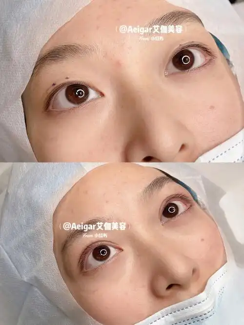 双眼皮刚做完就这么自然