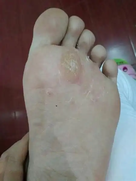 脚长硬皮湿疹中药秘方