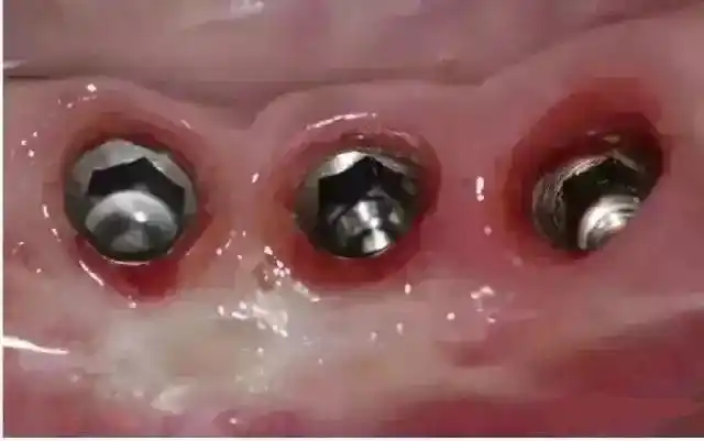 种植牙戴入难度与带入流程_螺丝