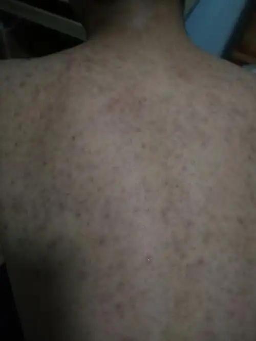 皮肤病 十五十六岁男孩子 后背 半个月前检查是皮囊炎 吃克拉霉素缓释