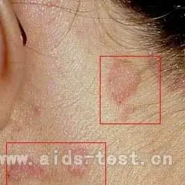 艾滋病人颈部皮疹图片