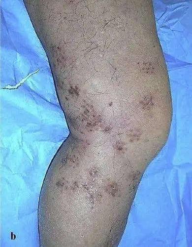 尤文肉瘤早期不啥症状?