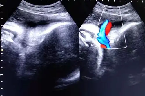 脐带缠绕超声如图所示:脐带绕颈对胎儿的影响视其缠绕松紧程度而不同