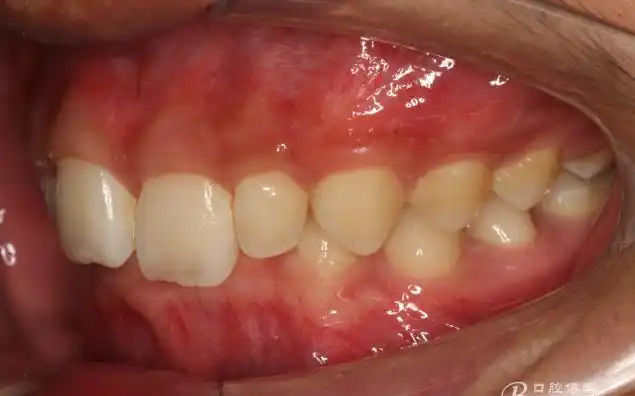 【原创博客】埋伏尖牙的外科电刀开窗导萌