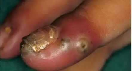 世界十大最恶心皮肤病皮肤蝇蛆病就是莲蓬乳图