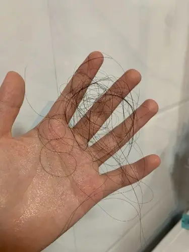 我是一名高中生,脱发严重,我想问一下,洗个头掉这么多头发正常吗,大概