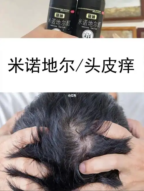 使用米诺地尔头皮痒怎么办