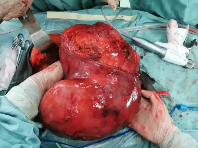 形似"桃心"的肿瘤