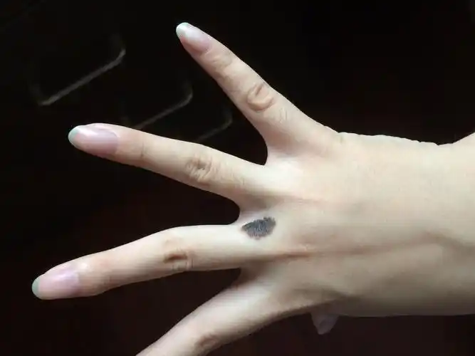 我右手中指无名指的指缝根部有一颗先天痣小时候挺小的我长
