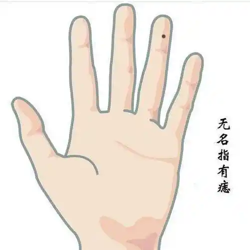 无名指侧面长痣容易出现桃花无名指代表着爱情,如果无名指侧面长痣,则