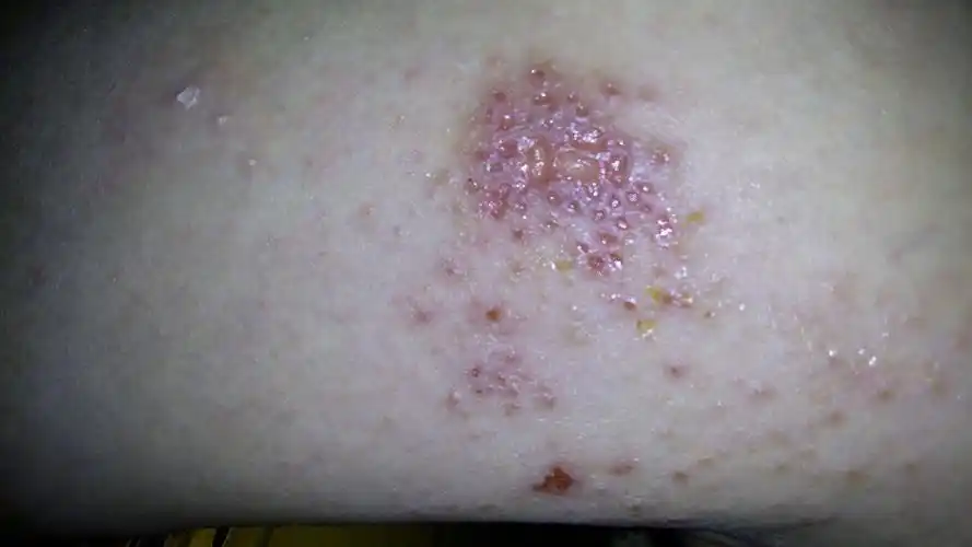 病人有10年糖尿病史,腿部因蚊虫叮咬挠破后渐渐腐烂演变成这样,并有