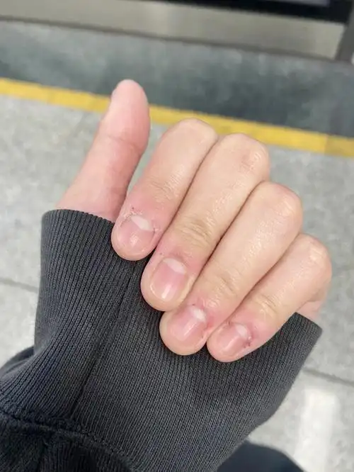 20多年的啃指甲星人终于下定决心去矫正咯.