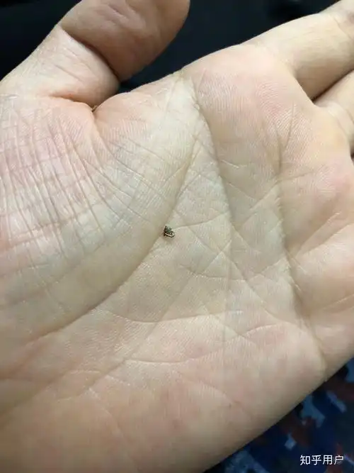 以上高难度的活都是媳妇帮我弄的 ,从做手术到取最后一颗钉子她都在