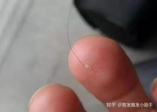 掉的头发根部有小白点,这是毛囊掉出来了吗?