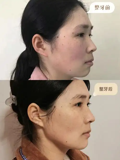 整牙前后同角度对比照来啦