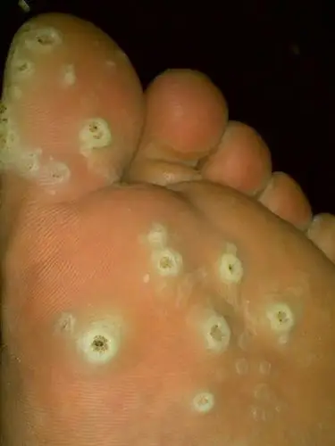 发现我患有密集恐惧症.