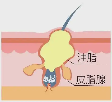 适量的油脂能在皮肤表层形成皮脂膜保护层,可以保护皮肤免受外界刺激.