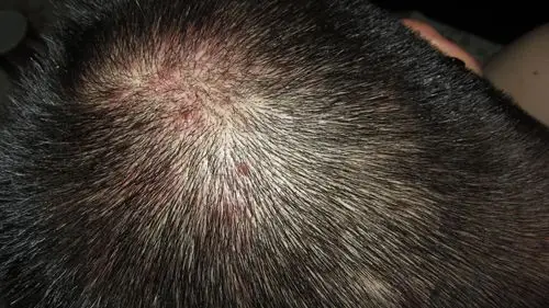 求妙手治疗穿凿性毛囊炎