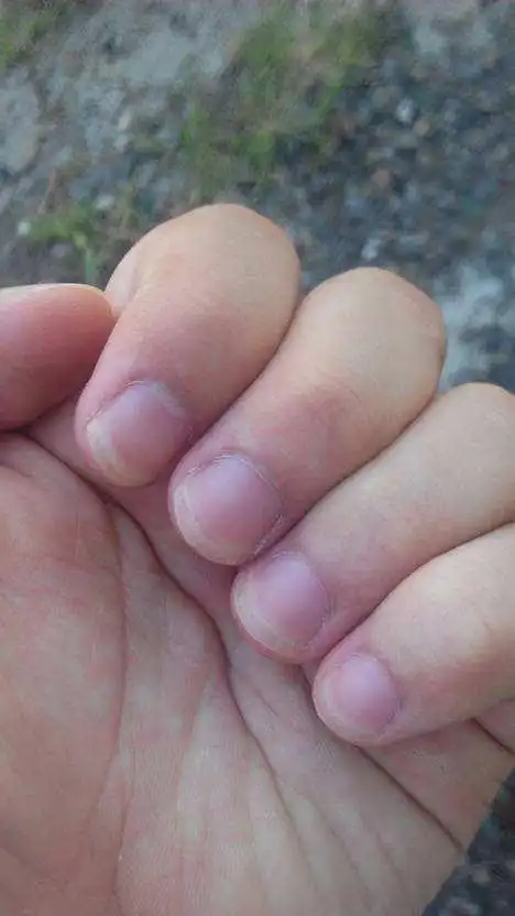 手指甲全部都慢慢的发黑发紫了,去医院抽血验金属也没超标心脏病手指