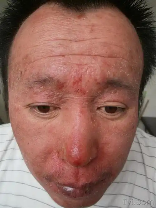 日光性湿疹 - 皮肤及性传播疾病讨论版 - 爱爱医医学论坛 - 爱爱医