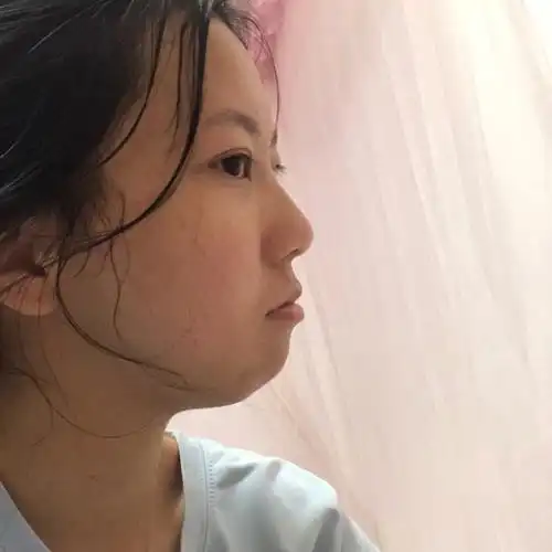 上牙的快要收完了,我觉得还是有效果的,#龅牙  #矫正牙齿   第一张图