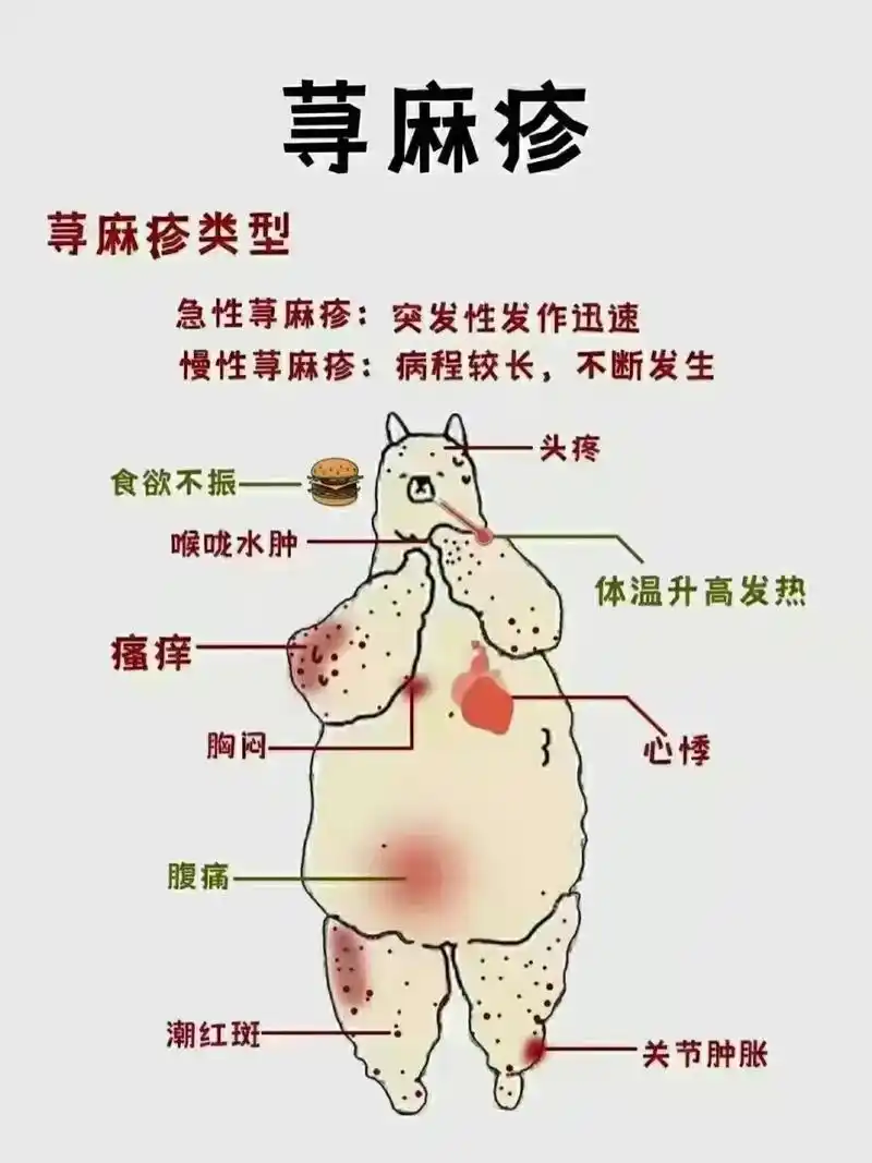 荨麻疹荨麻疹类型急性荨麻疹:突发性发作迅速慢性荨麻疹:病程较 - 抖