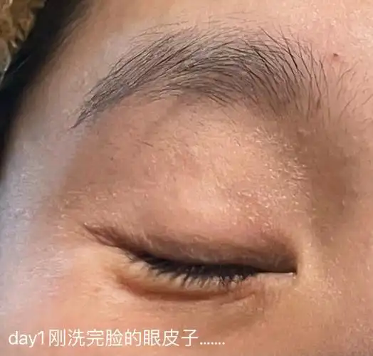 涂手脚皴裂的尿素乳膏下手了……属实是没想到这玩意儿这么猛(没有