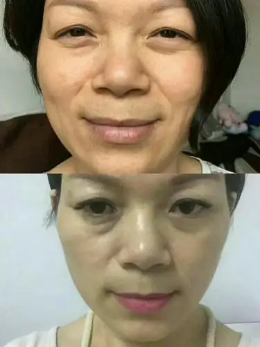 莱芙蔻"抗衰老生命密码护肤品祛斑祛痘去褶皱"产品使用前后惊人对比图