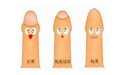 包皮过长,包茎的危害有哪些?什么情况下需要手术治疗?