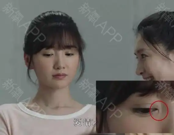 毛晓彤眼角这是疤痕还是内眦赘皮?