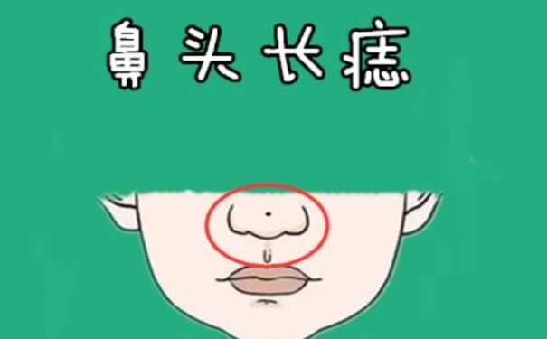 小人痣长在哪里身上有的赶紧去点掉