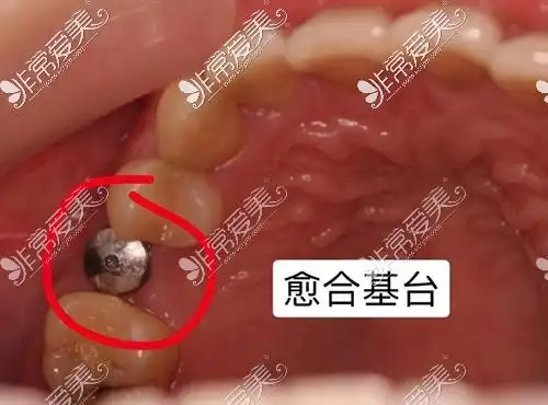 种植牙二期愈合基台展示
