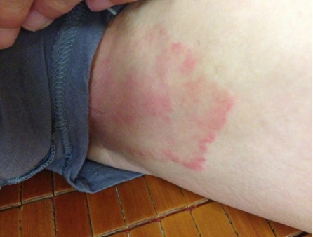 体股癣初期现象图片8