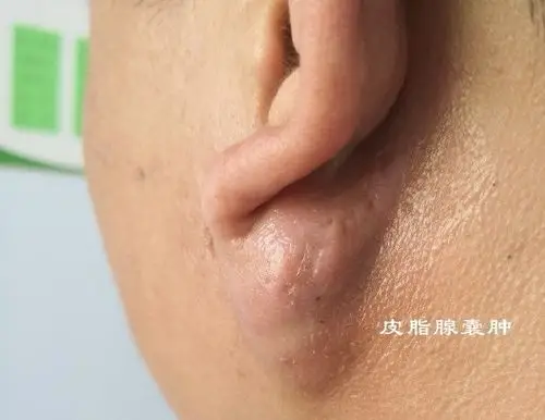 毛囊炎疖痈皮脂腺囊肿怎么区分