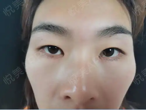 综合手术当天_开眼角手术当天_双眼皮手术当天_眼部整形手术当天_狐狸