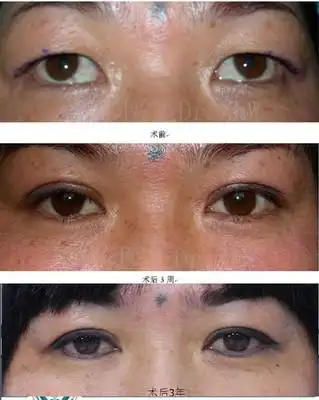 老年性重睑术后3周及3年