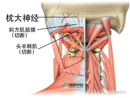 枕大神经卡压针刀治疗