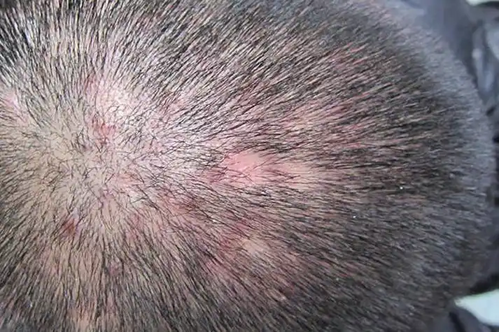 头皮毛囊炎疙瘩图