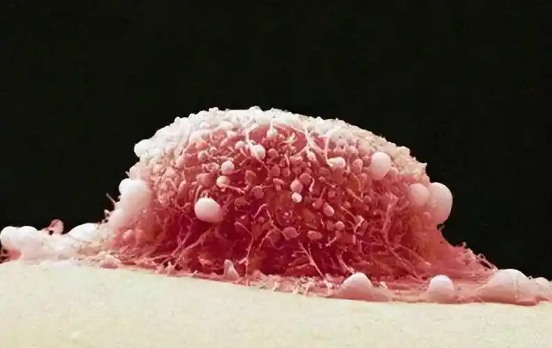 "外阴癌"都是拖出来的?