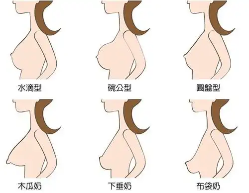 水滴型果冻矽胶隆乳前不看会后悔的十件事!