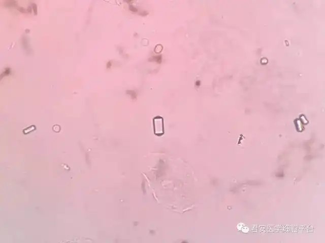 0 镜下可见如下结晶: 第一次尿液检查(上午) 两次尿液检查,同样加冰